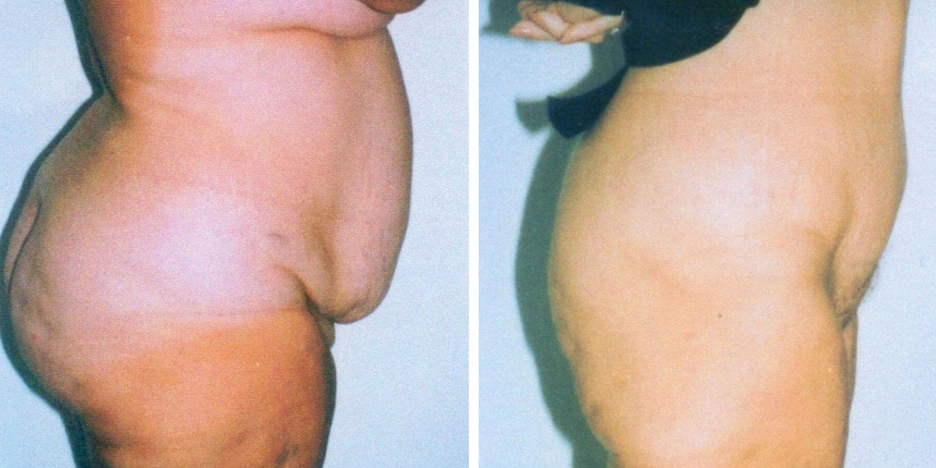 Comparativa antes y después en una mujer de una abdominoplastia en Madrid