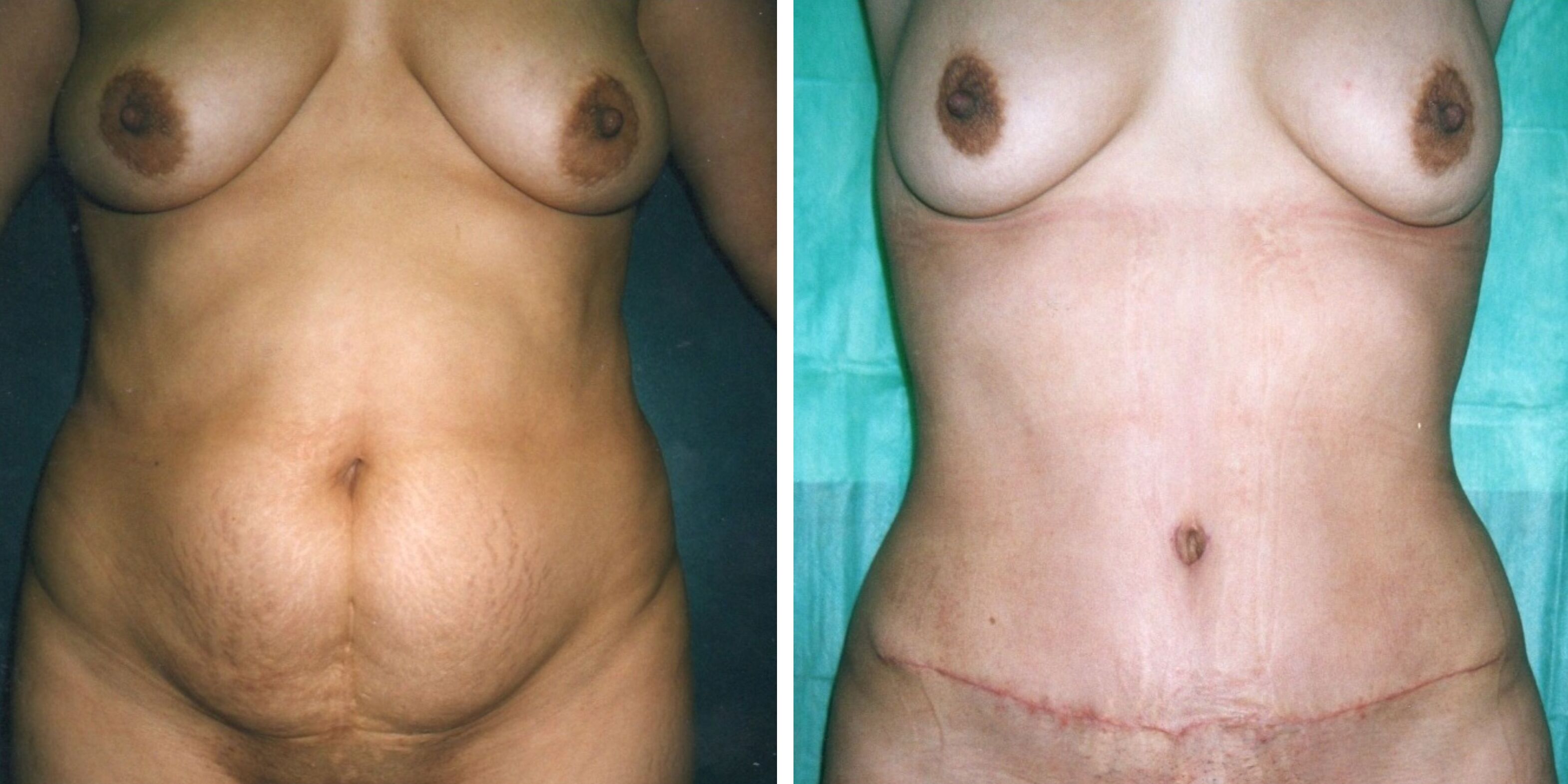 Comparativa antes y después en otra mujer de una abdominoplastia en Madrid