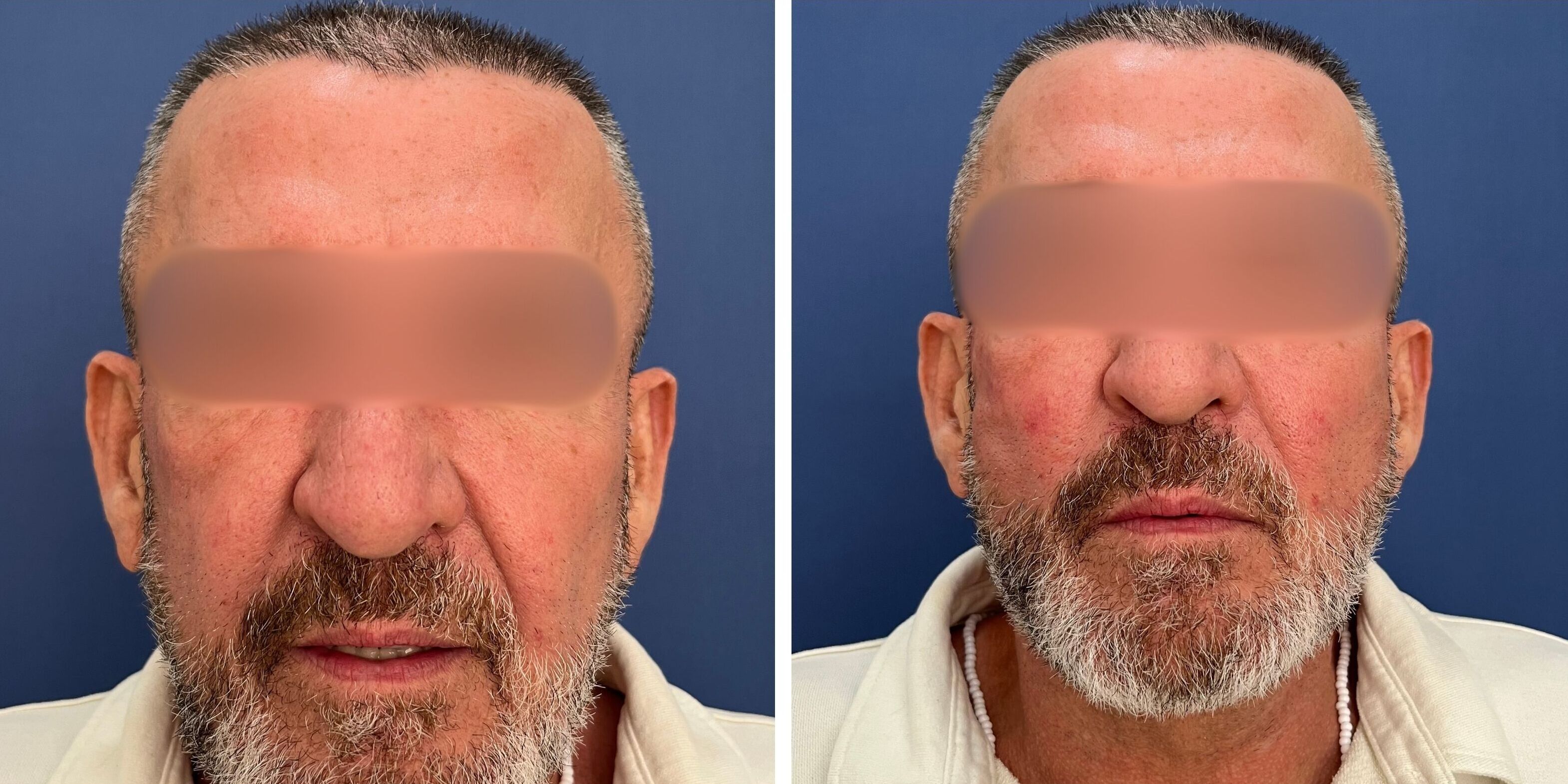 Comparativa antes y después en un hombre de un tratamiento de hilos tensores en Madrid