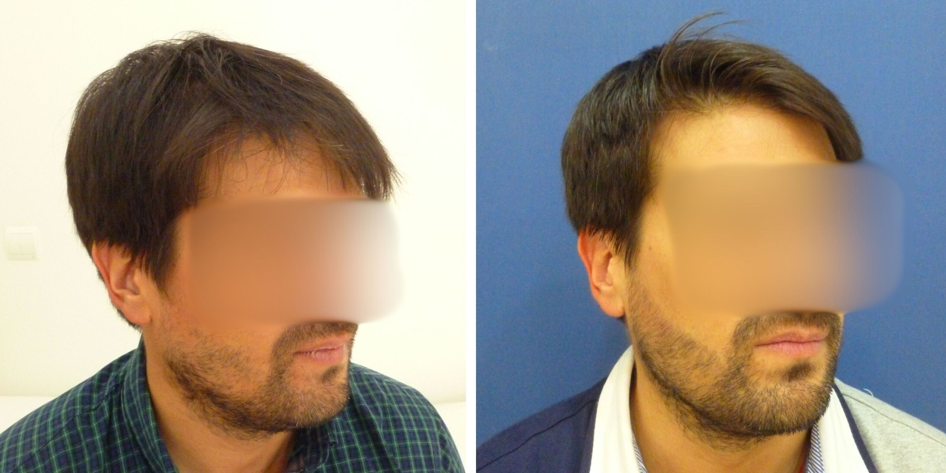 Comparativa antes y después en un hombre del injerto de barba en Madrid