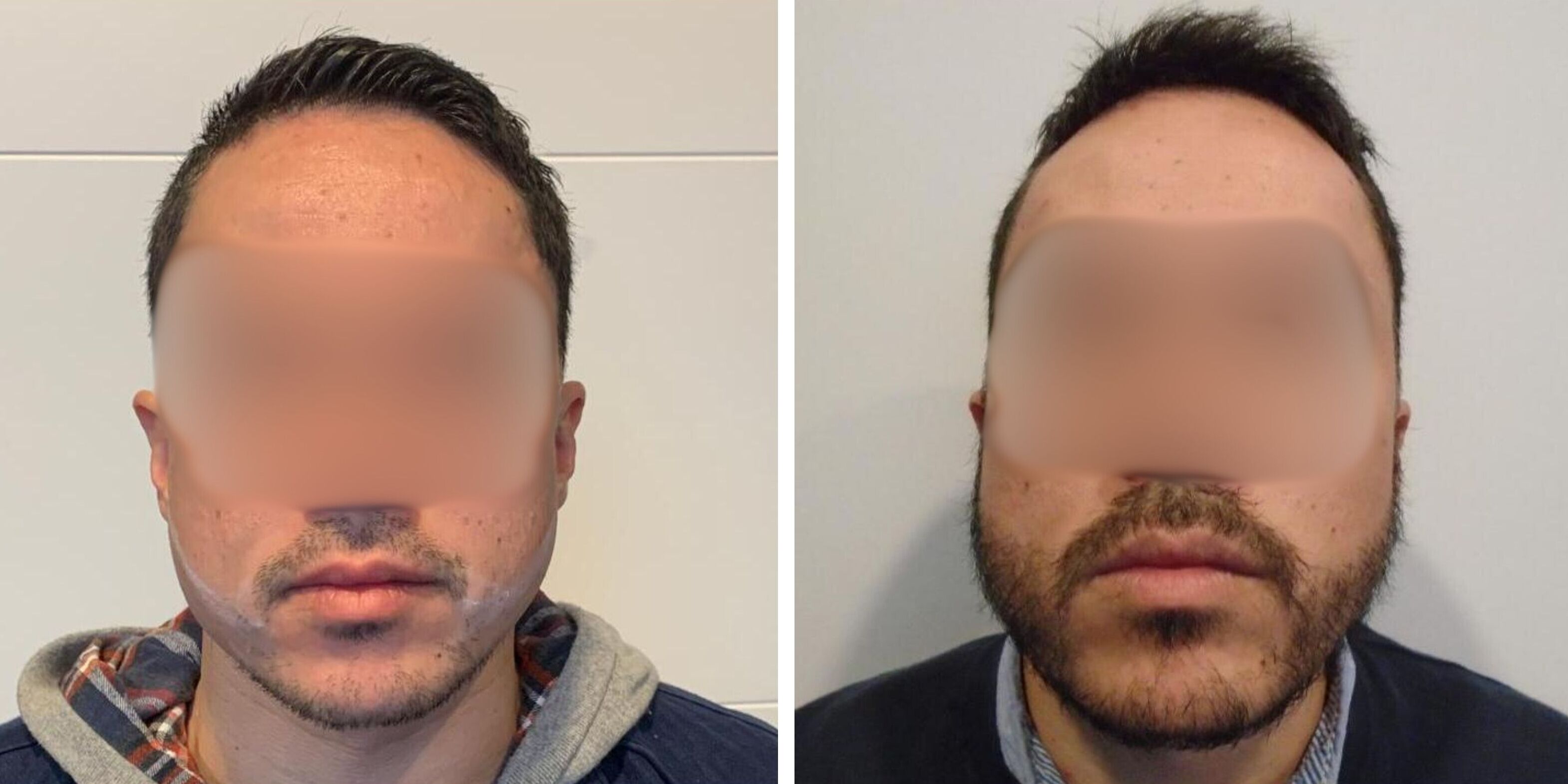 Comparativa antes y después en otro hombre del injerto de barba en Madrid