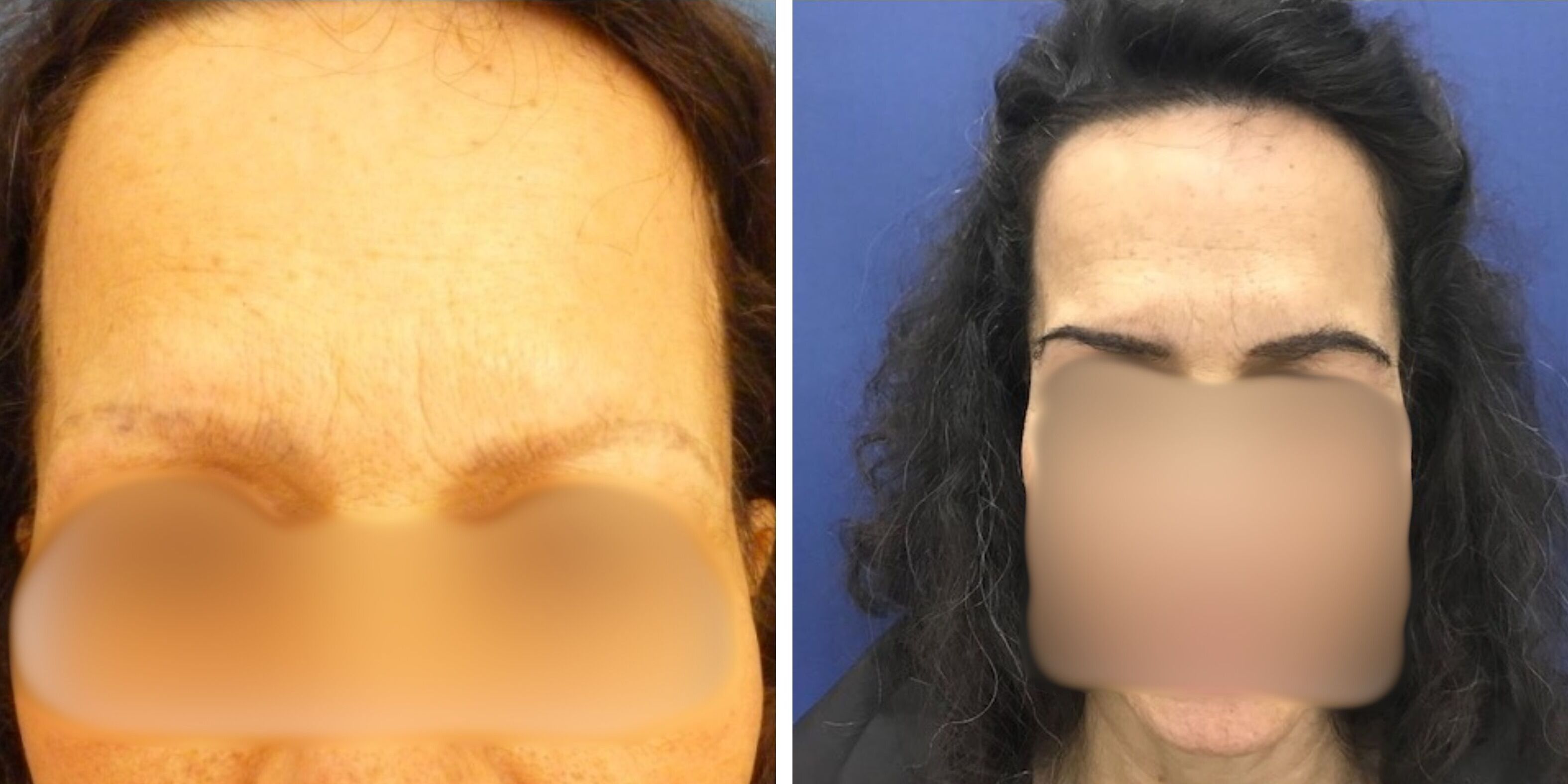 Comparativa antes y después de otra mujer operada de injerto de cejas en Madrid