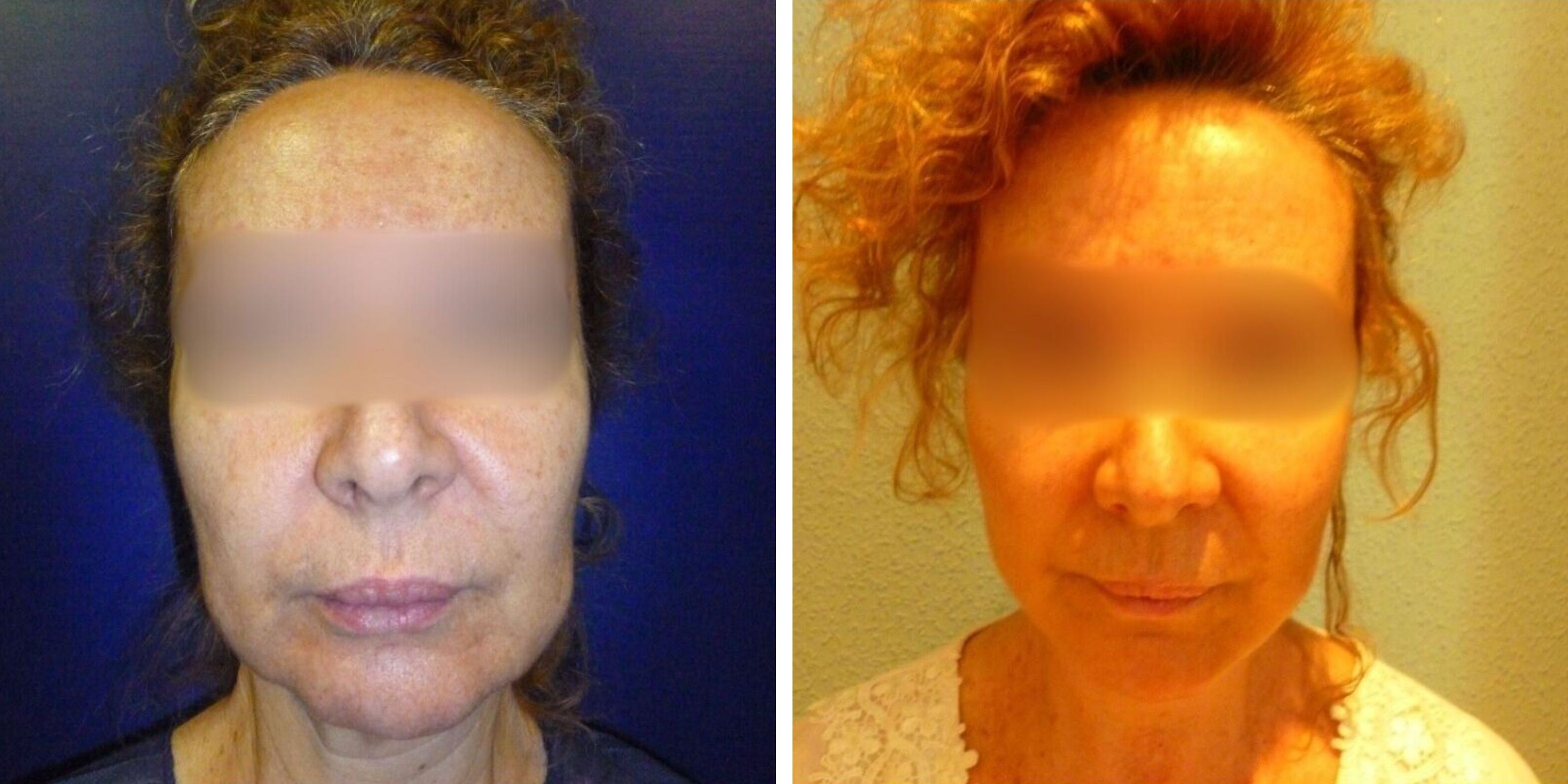 Comparativa antes y después en una mujer de un lifting facial en Madrid