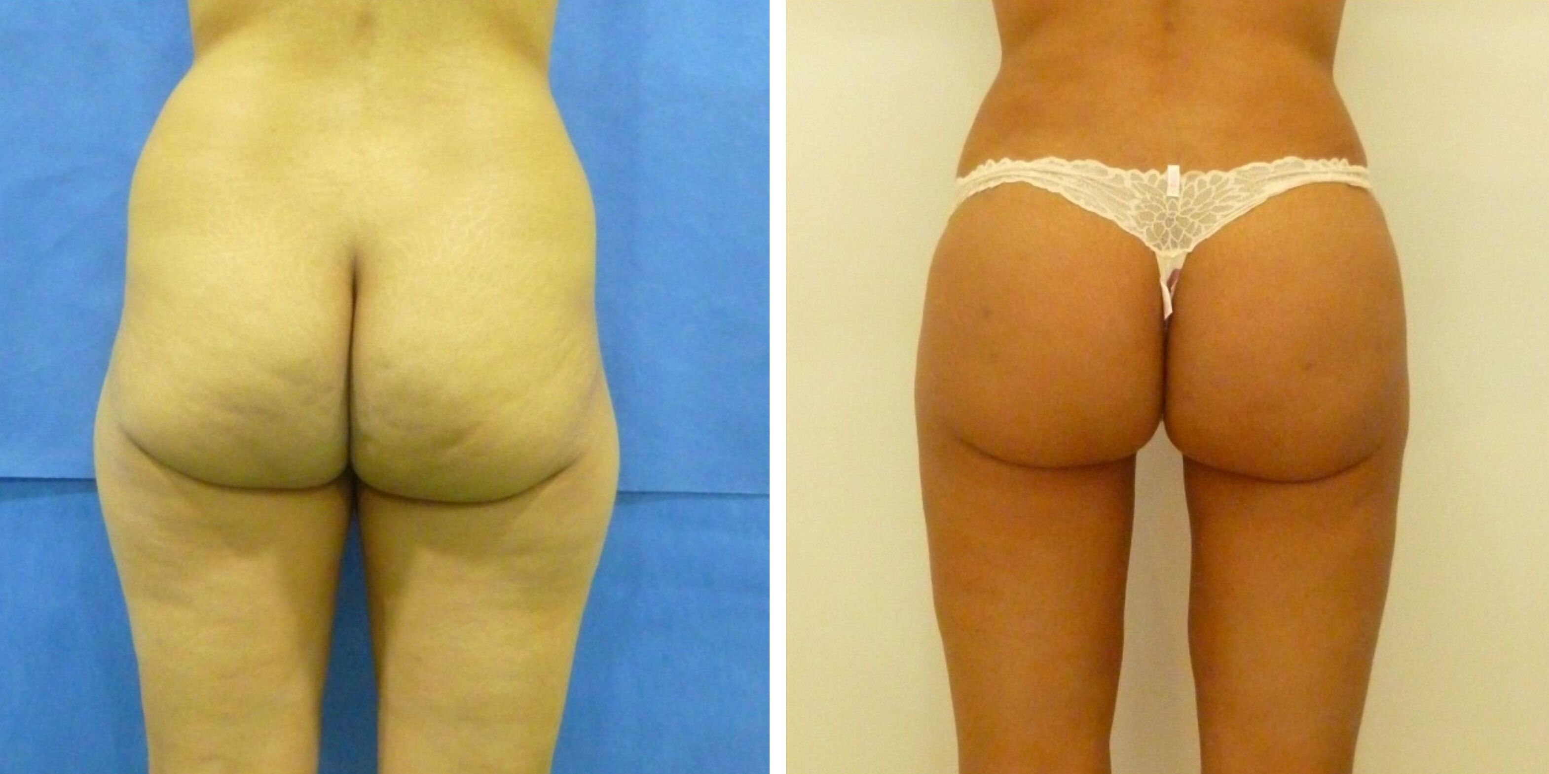 Comparativa antes y después en una mujer de una lipoescultura en Madrid, vista trasera