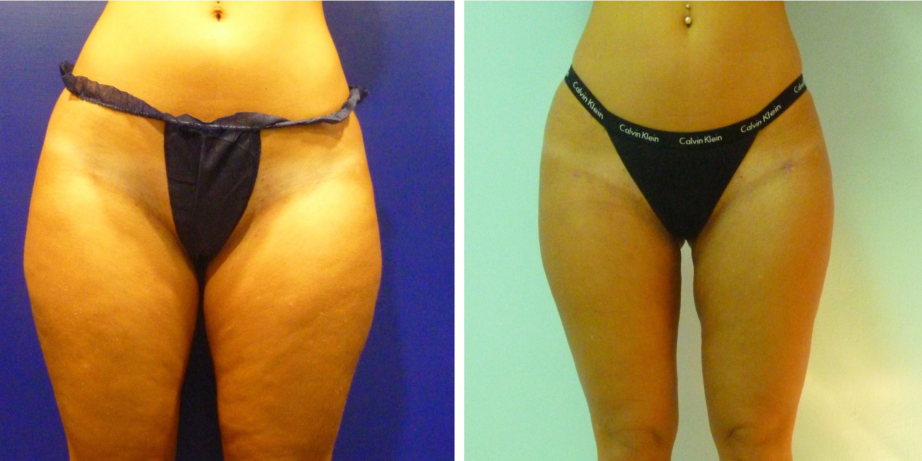 Comparativa antes y después en otra mujer de una lipoescultura en Madrid, vista frontal