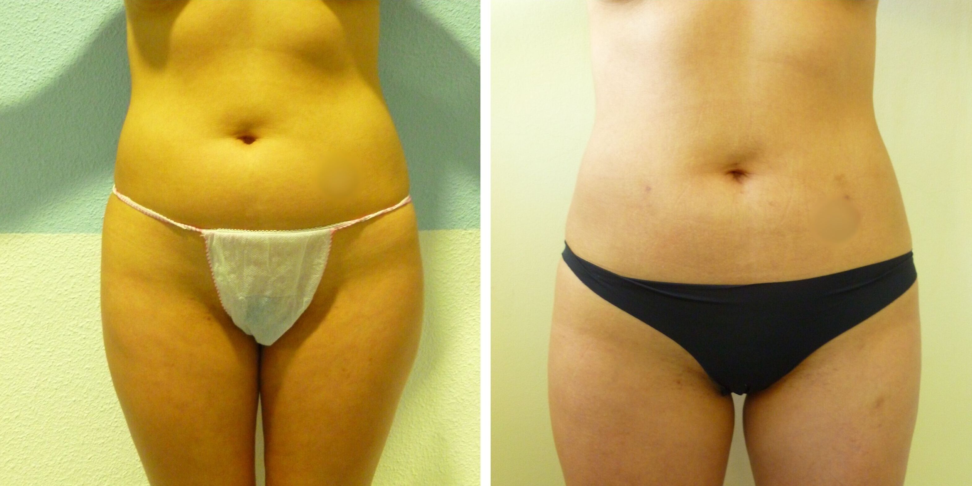 Vista frontal de comparativa antes y después en otra mujer de una liposucción láser en Madrid