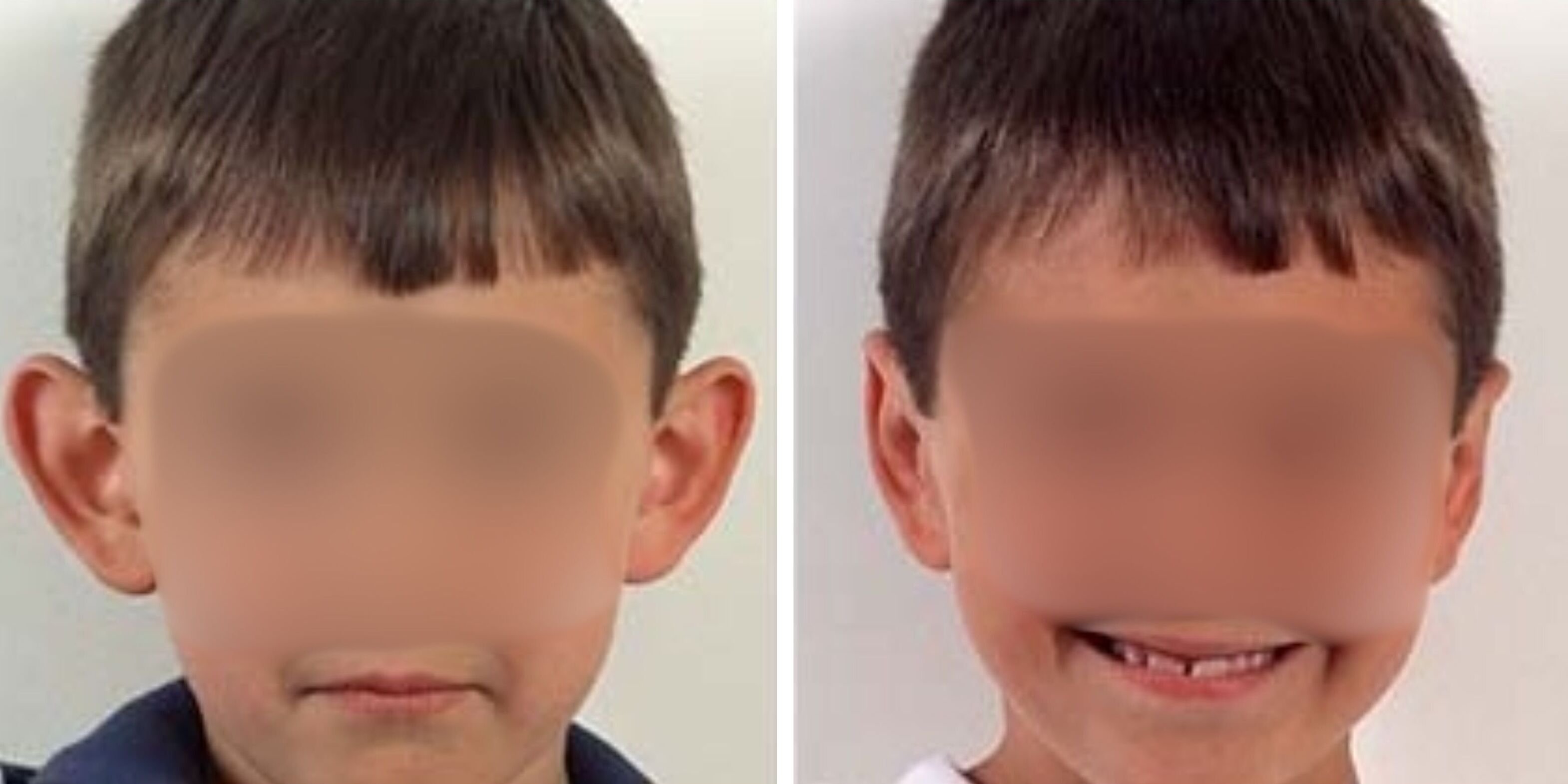 Comparativa antes y después en un niño de una otoplastia en Madrid