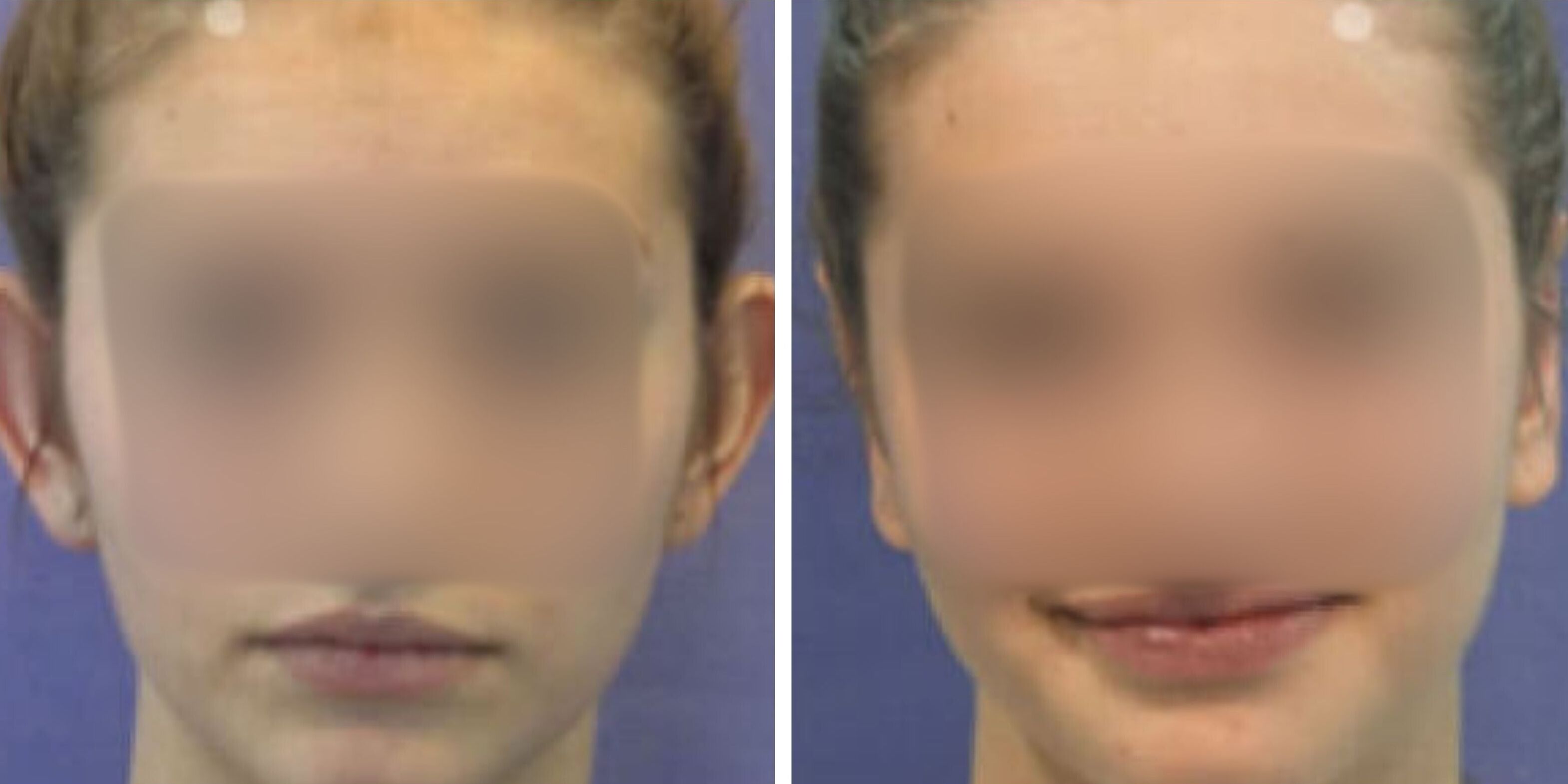 Comparativa antes y después en una mujer de una otoplastia en Madrid