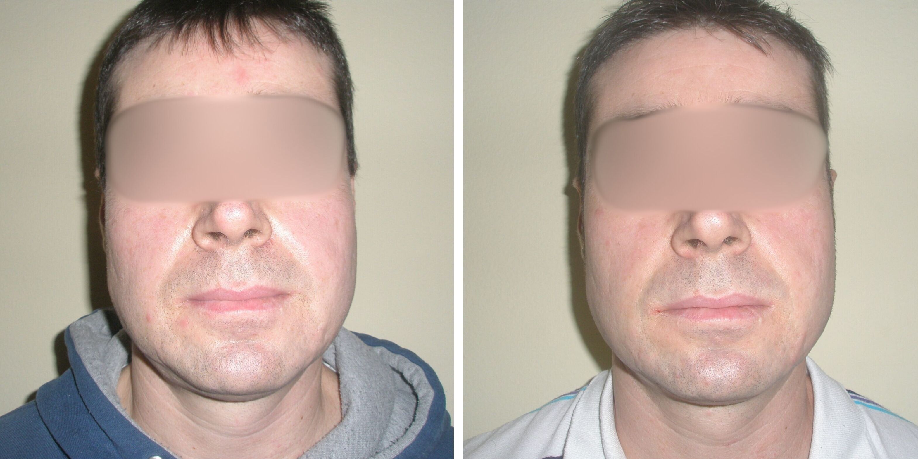 Comparativa antes y después en un hombre de un peeling facial en Madrid